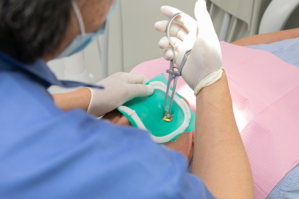 ラバーダムを活用した根の治療