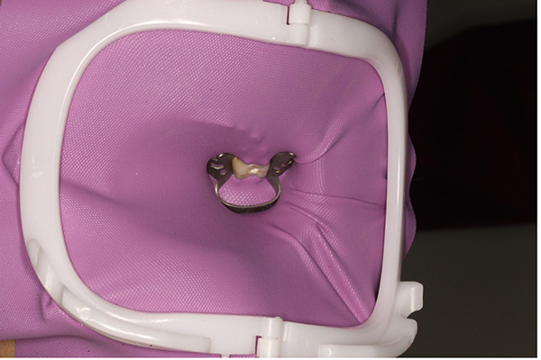 ラバーダムを活用した根の治療