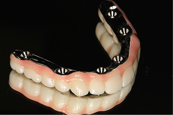 インプラントシステム