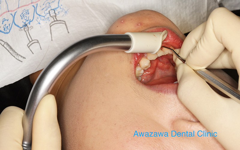 ルートプレーニング