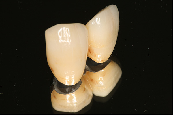 メタルボンドクラウン