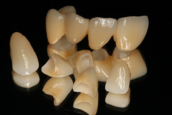 オールセラミッククラウン