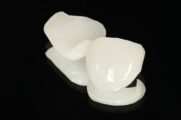 ラミネートベニア