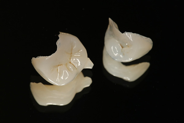 セラミックインレー