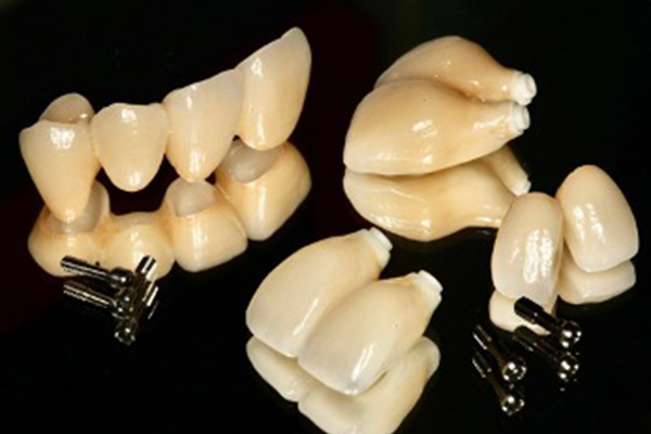 インプラントシステム